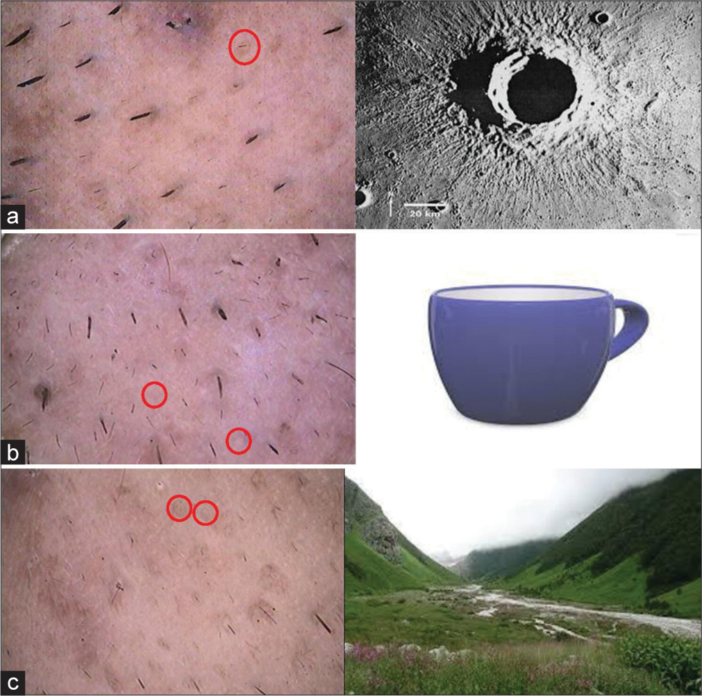 Dermoscopy as a novel tool to examine and assess treatment response of acne scars: A pilot study in an Indian population