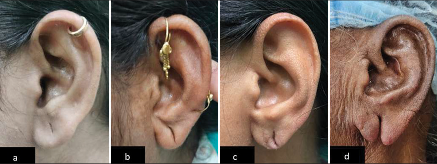 Innovative technique for partial earlobe tear repair using a customized elliptical biopsy punch