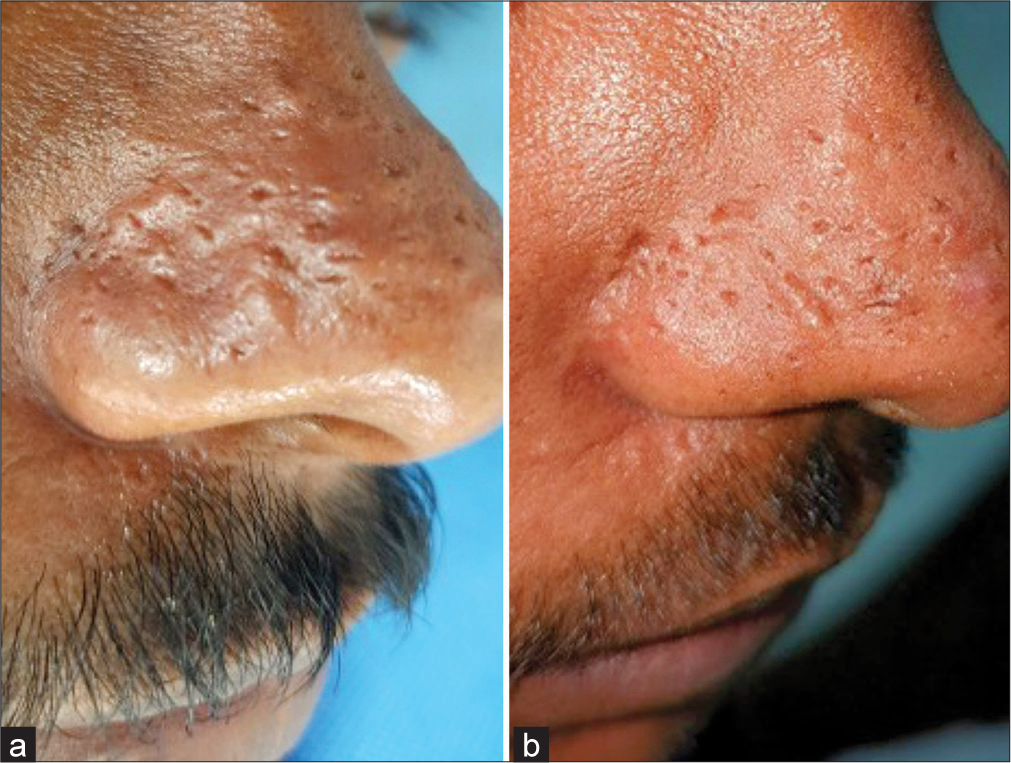 Versatile use of acupuncture needles for radiofrequency ablation in skin appendageal and other disorders