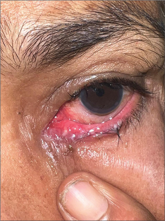 The deception of acantholysis: The painful and overlooked story of ocular surface squamous neoplasia in a red eye