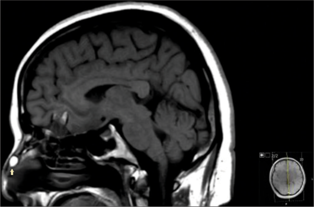 Nasal dermoid sinus cyst with intracranial extension and atretic sinus tract in an adult patient