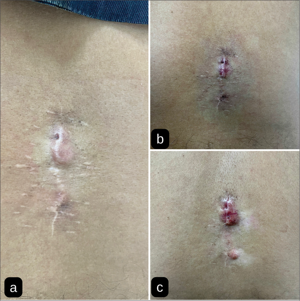 Leiomyoma mimicking hypertrophic scar/keloid over the surgical incision site