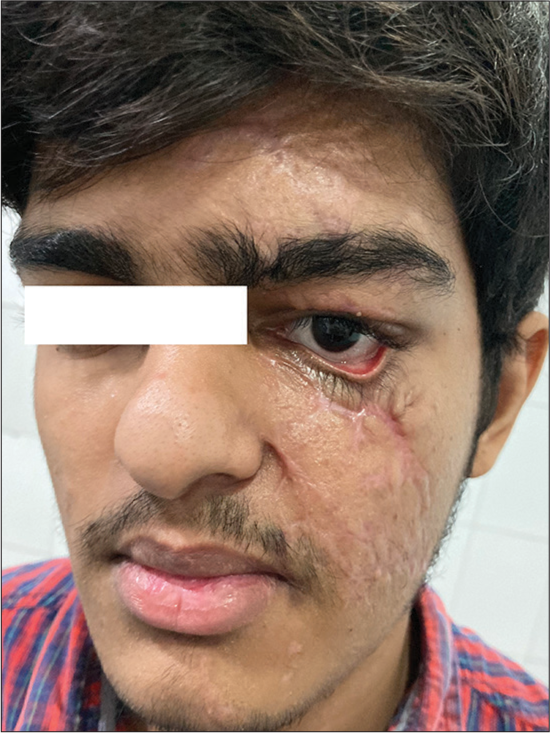 Innovative post-traumatic ectropion repair – A case report