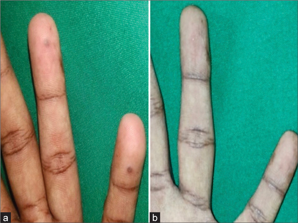 Effectiveness of intralesional bleomycin in the management of difficult-to-treat and resistant cutaneous warts in a tertiary care teaching hospital in Puducherry: A quasi-experimental study