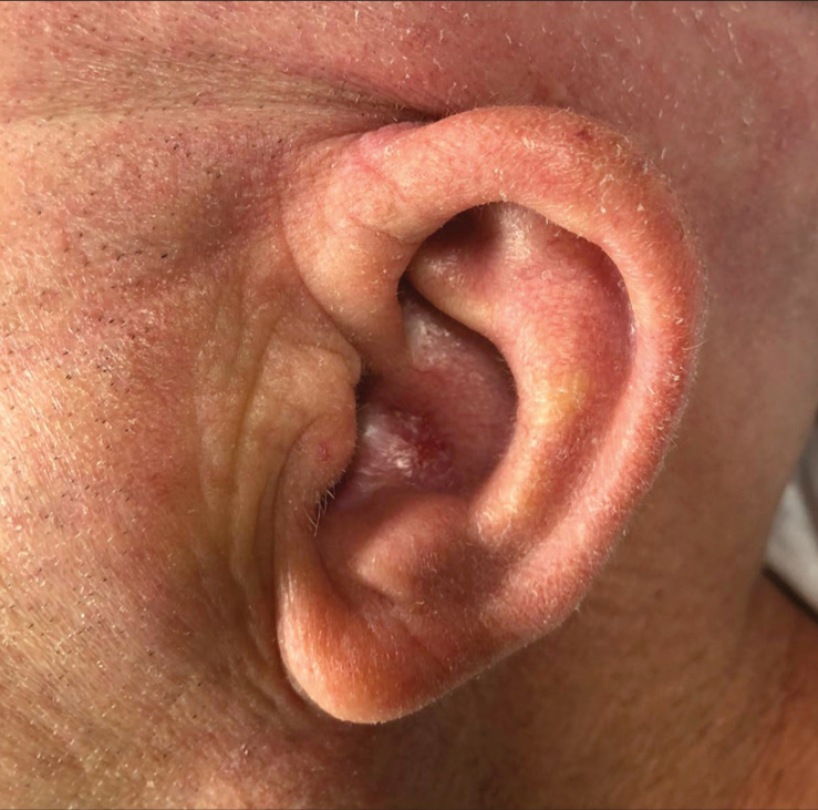 Ear concha carcinoma: excision and repair with an innovative revision of Masson’s post-auricular revolving-door flap (flip-flop flap)