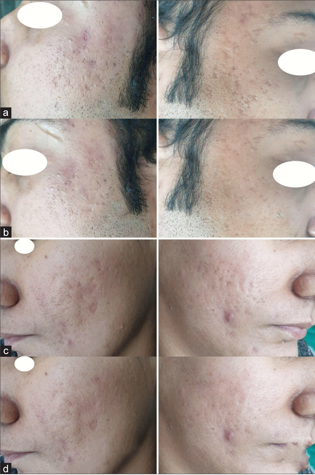 Efficacy of autologous platelet rich plasma with subcision vs platelet rich plasma with microneedling in atrophic acne scars: A single-center, prospective, intra-individual split-face comparative study