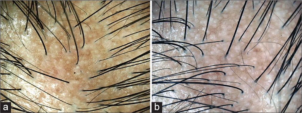 Efficacy and safety of microneedling radiofrequency in patterned hair loss