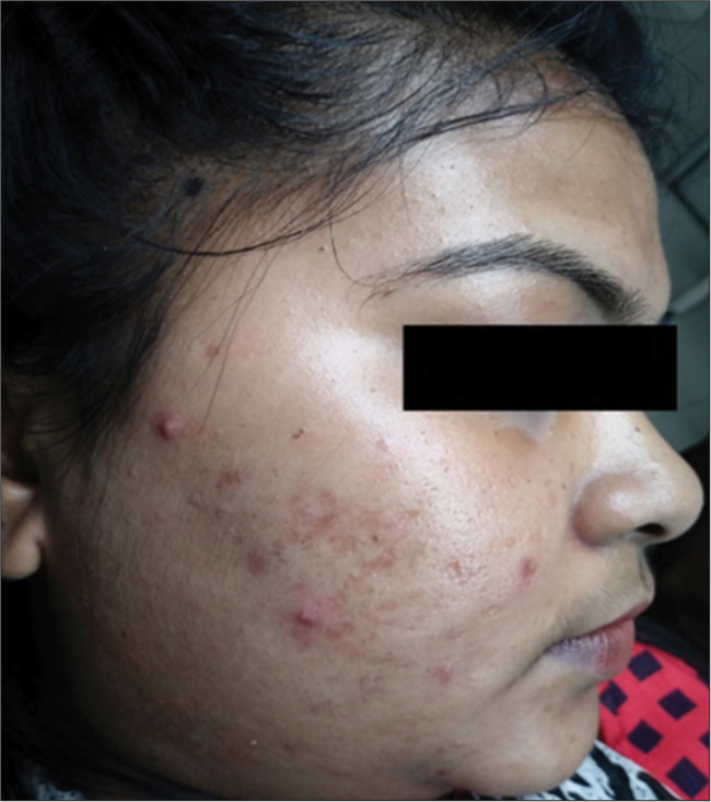 Study to compare the efficacy of 50% glycolic acid with 65% trichloroacetic acid in the treatment of atrophic acne scar by CROSS technique