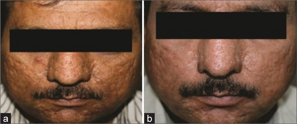 Comparative study in treatment of acne scars fractional carbon dioxide laser versus micro needling fractional radio frequency – A retrospective study