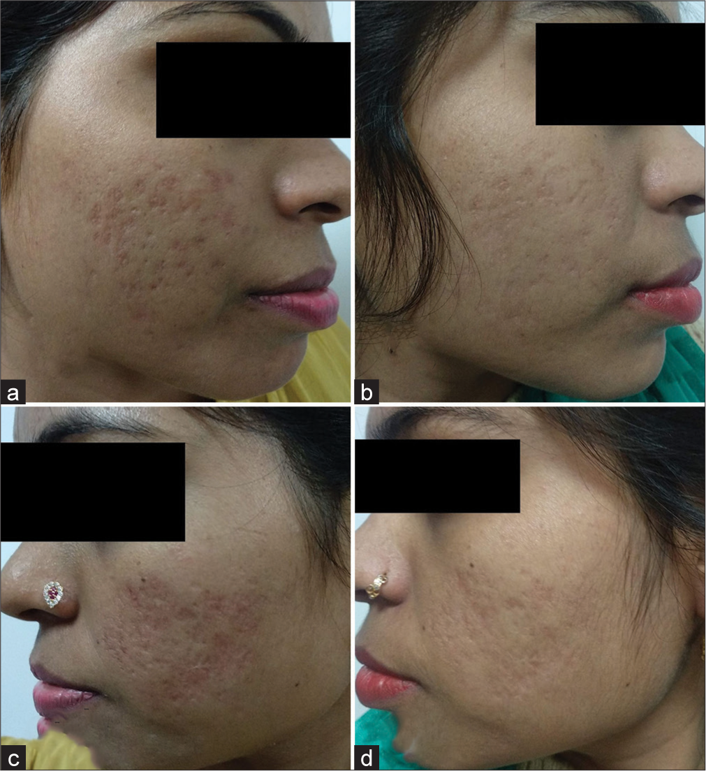 A comparative study of 70% glycolic acid and 30% trichloroacetic acid peel in the treatment of facial atrophic acne scars: A split-face study