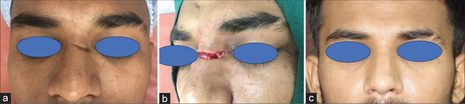 Elliptical excision and primary closure of nasal defect to achieve best esthetic outcome: A case series of 50 patients