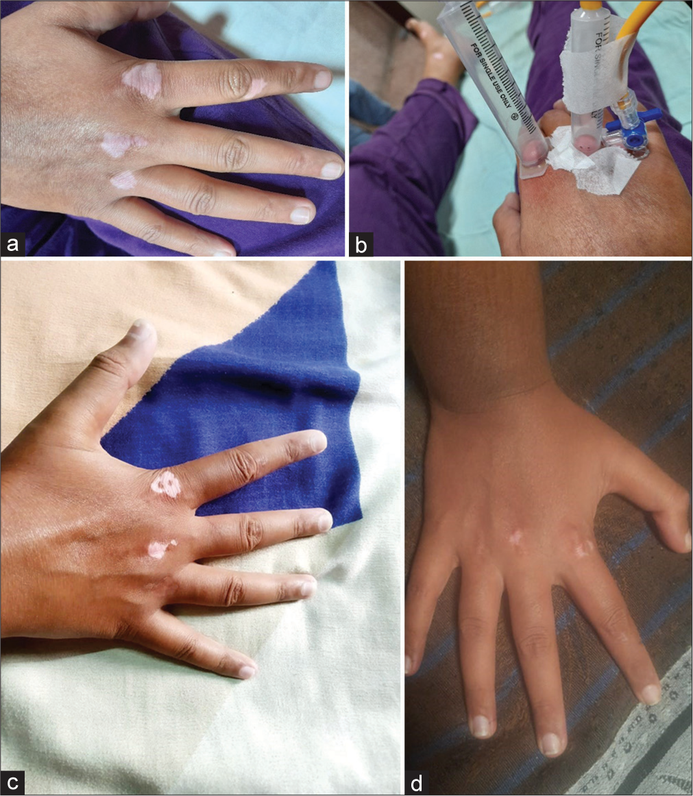 To study the efficacy of autologous non-cultured nontrypsinized epidermal cell grafting (Jodhpur technique) by using of suction blister membrane in stable vitiligo