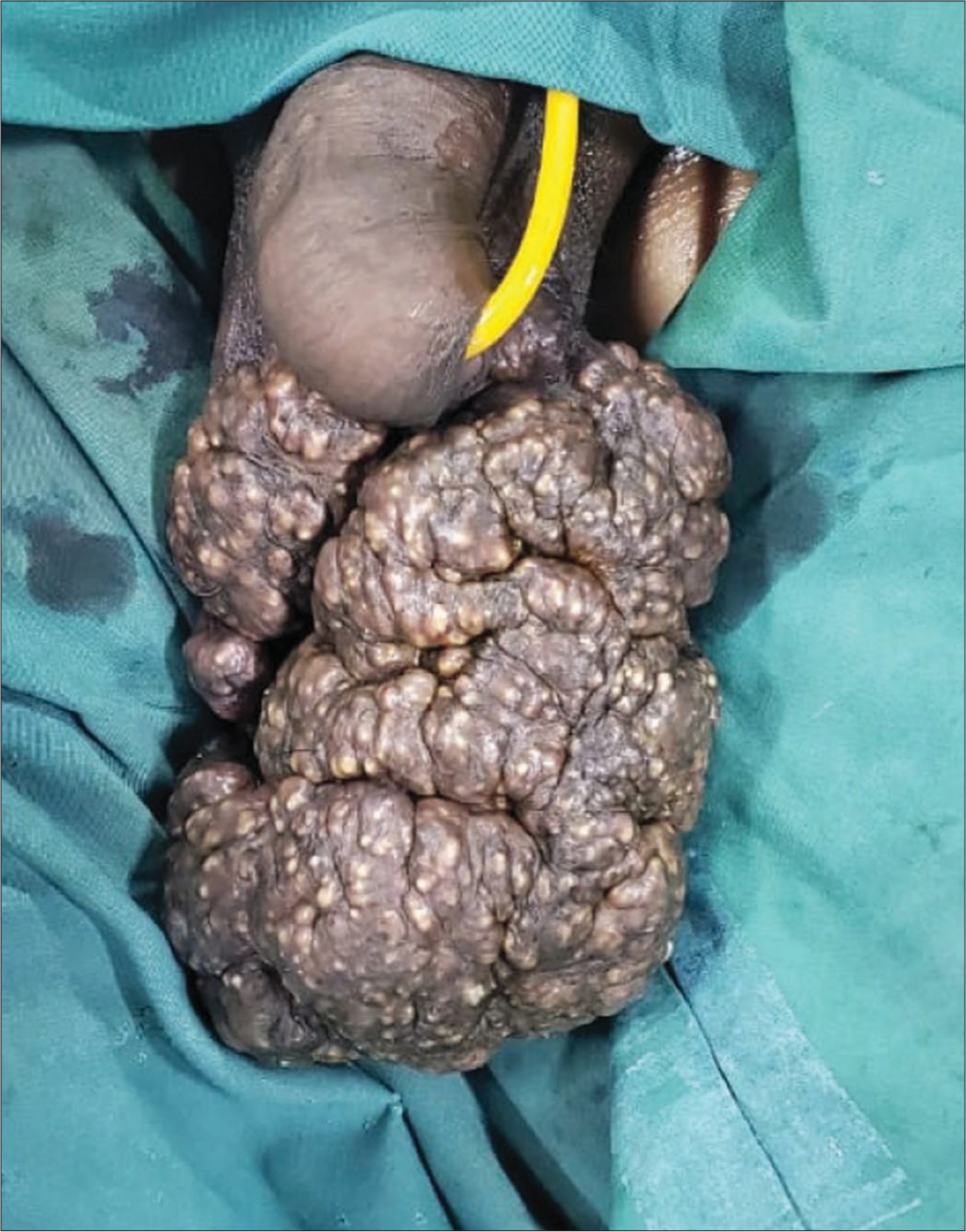 Giant trichilemmal cyst of scrotum