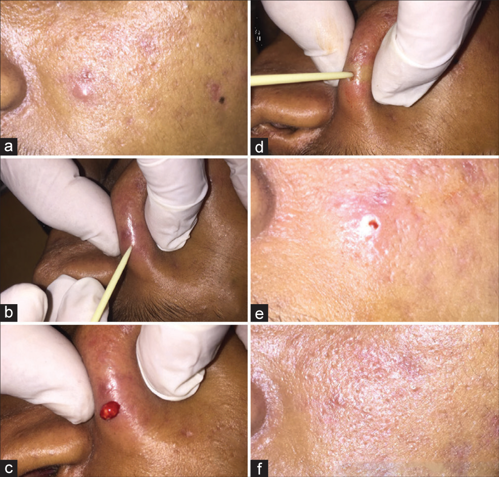 Intralesional chemical cautery of papulonodular acne