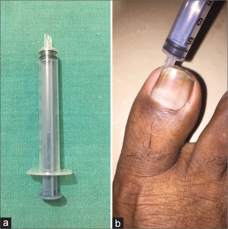 A customized syringe for separating ingrown toe nail from the gutter