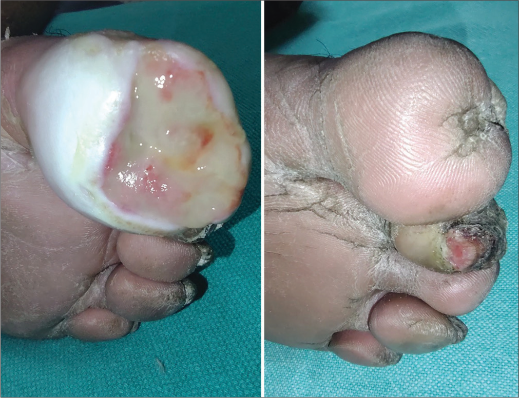 Platelet-rich fibrin therapy in the management of nonhealing trophic ulcers due to underlying leprous neuropathy