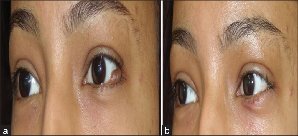 A pilot study on the efficacy of 10600 nm carbon dioxide laser ablation in treatment of eyelid margin lesions