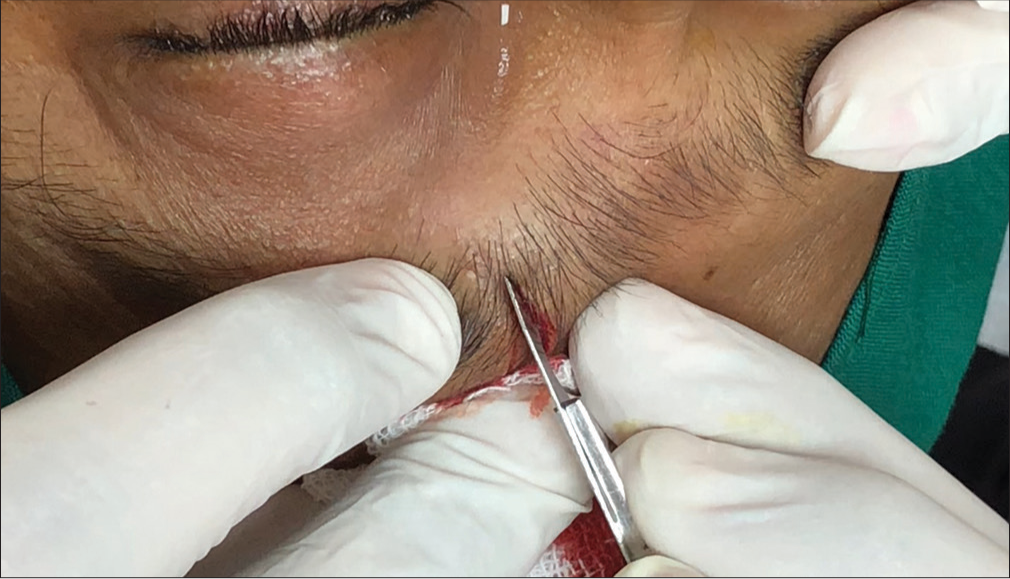 Eyebrow reconstruction by simple elliptical excision with beveled incision – A case series of twelve patients