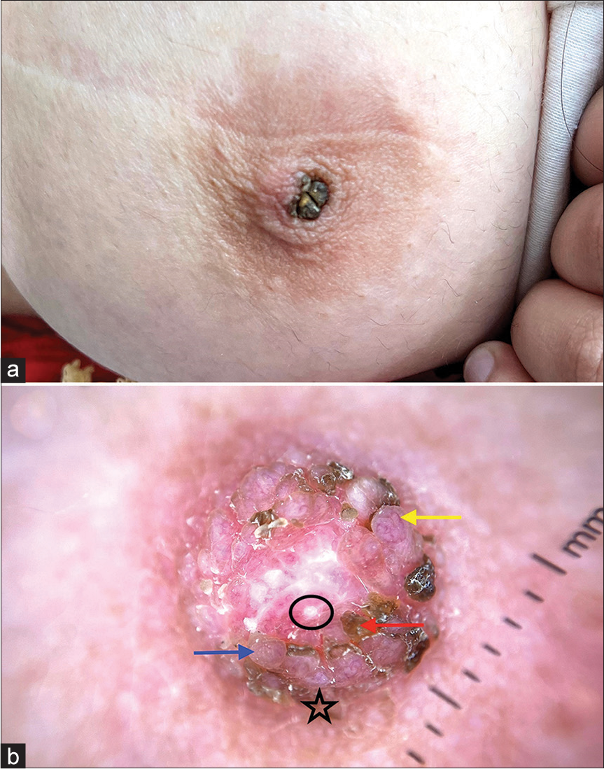 Dermoscopy of nevoid hyperkeratosis of the nipple and/or areola in Fitzpatrick skin type IV