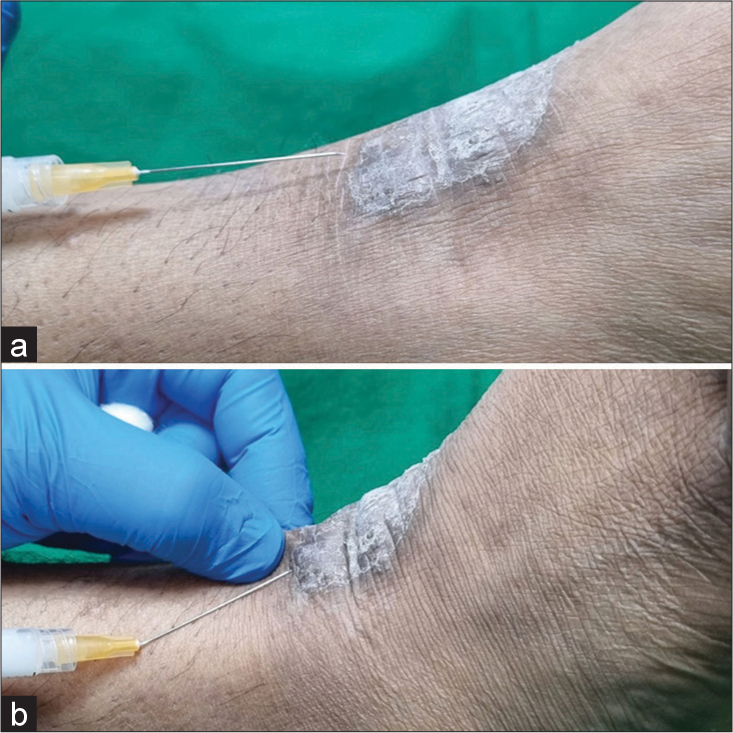 Intralesional drug delivery with a bent needle