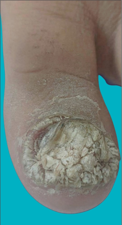 Seal and heal: A novel deal for periungual wart