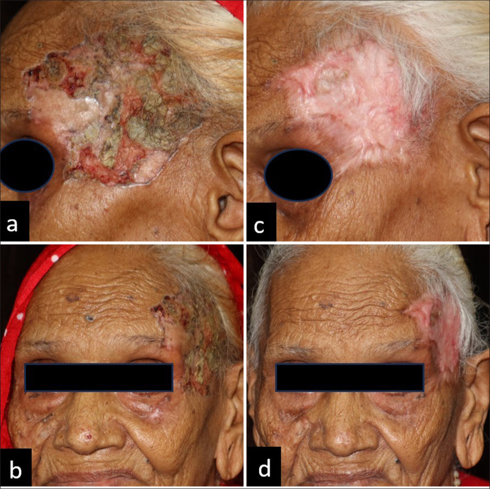 Carbon dioxide laser ablation in the treatment of basal cell carcinoma in an elderly female