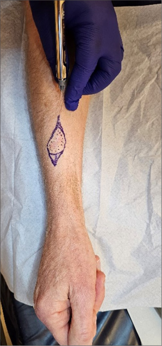 A resident’s guide to skin cancer minor surgery