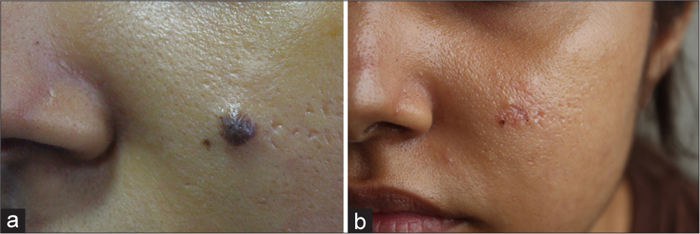 Osteonevus of Nanta: A rare presentation in a young female with comprehensive dermoscopic and histopathological findings