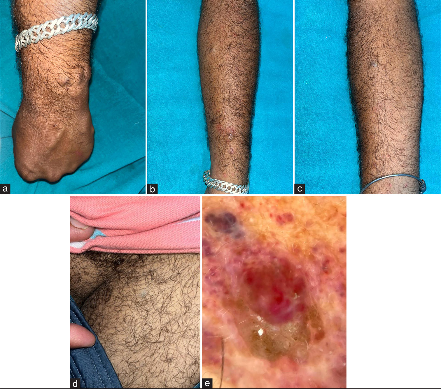 Unravelling Masson’s tumor: A rare case of atypical presentation with comprehensive clinico-histopathological and radiological correlation