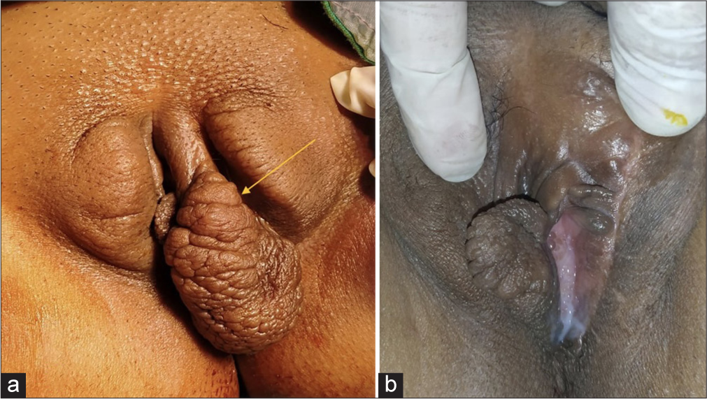 In the face of a rare foe: Aggressive angiomyxoma of the vulva – A case report and literature review