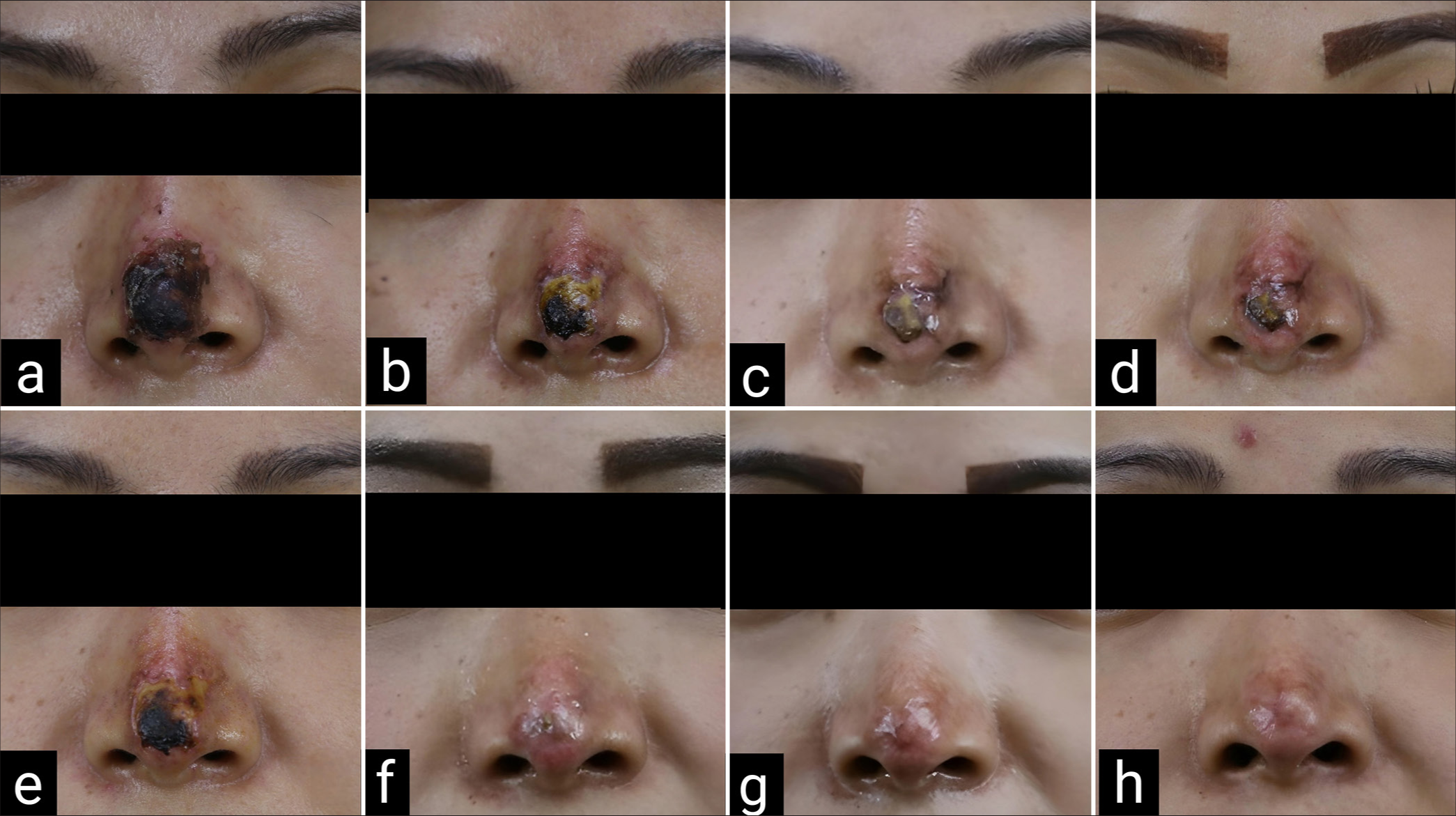 Correction of nasal skin necrosis after filler injection with micro and nanofat grafting