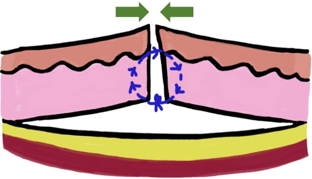 Push-pull suture
