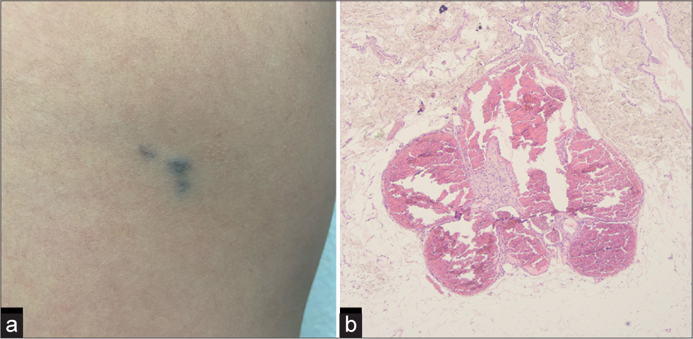 Familial multiple glomuvenous malformations: The role of 1064-nm neodymium-doped yttrium aluminum garnet laser