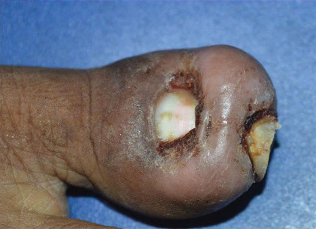 Unravelling harpoon nail: Surgical outcome and insights