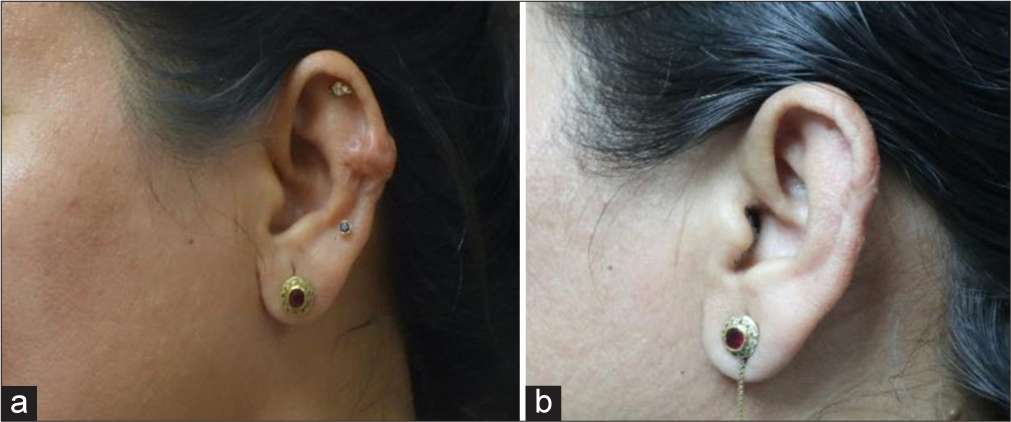Maximizing keloid treatment efficacy: Enhanced results through the synergy of erbium glass laser and intralesional steroids