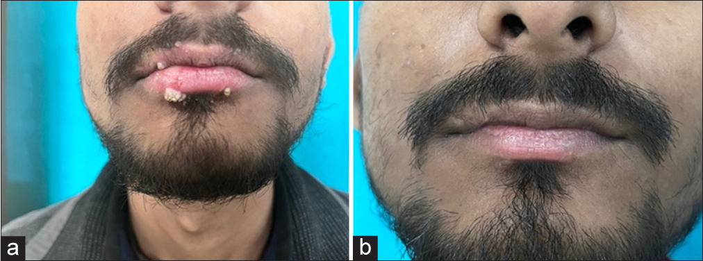 Long-pulsed neodymium-doped yttrium aluminum garnet laser as a therapeutic modality in untreated and recalcitrant warts