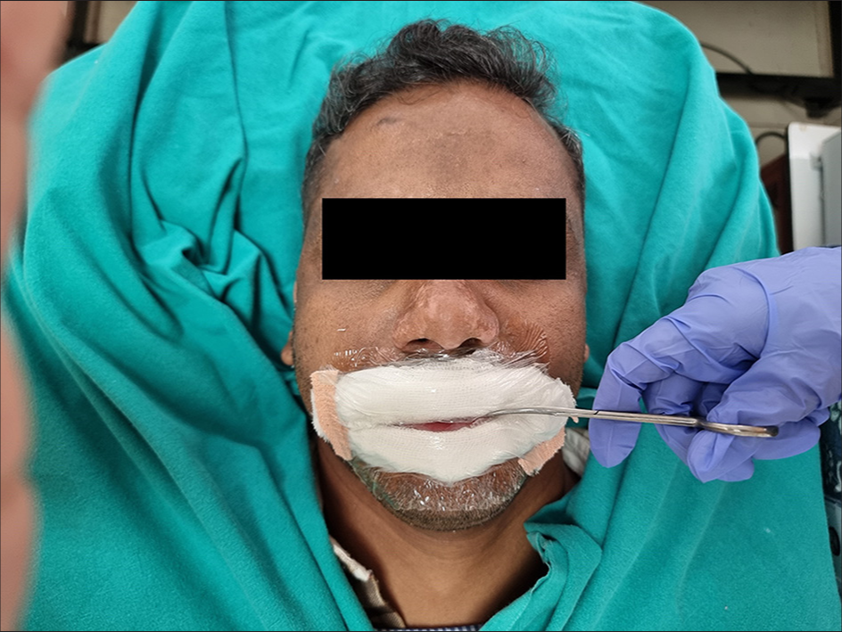 Innovative slit lip dressing for optimal blister graft success in vitiligo