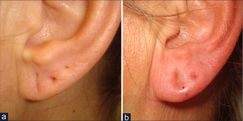 Esthetic and reconstructive options for earlobe deformities