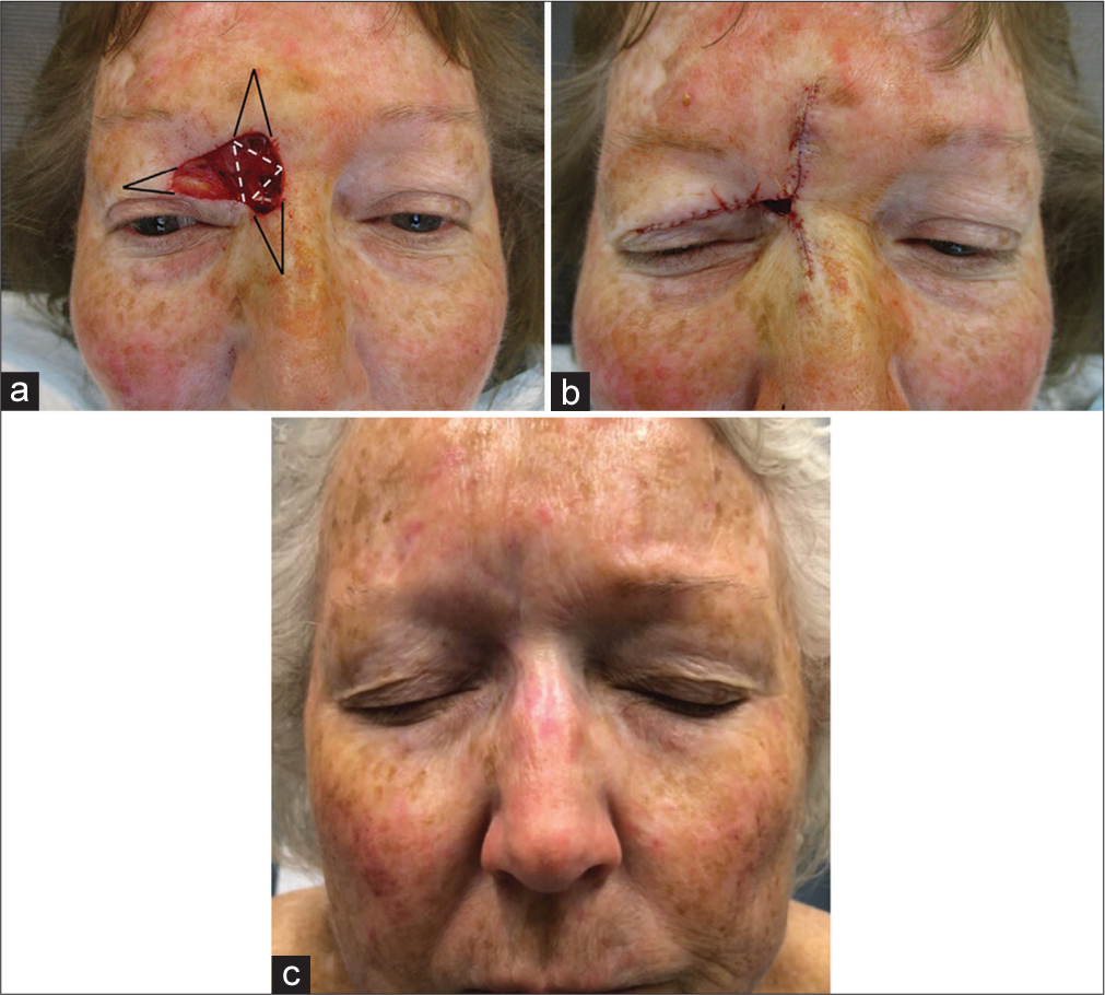 Broadening the scope and utility of the triple advancement flap in Mohs surgery