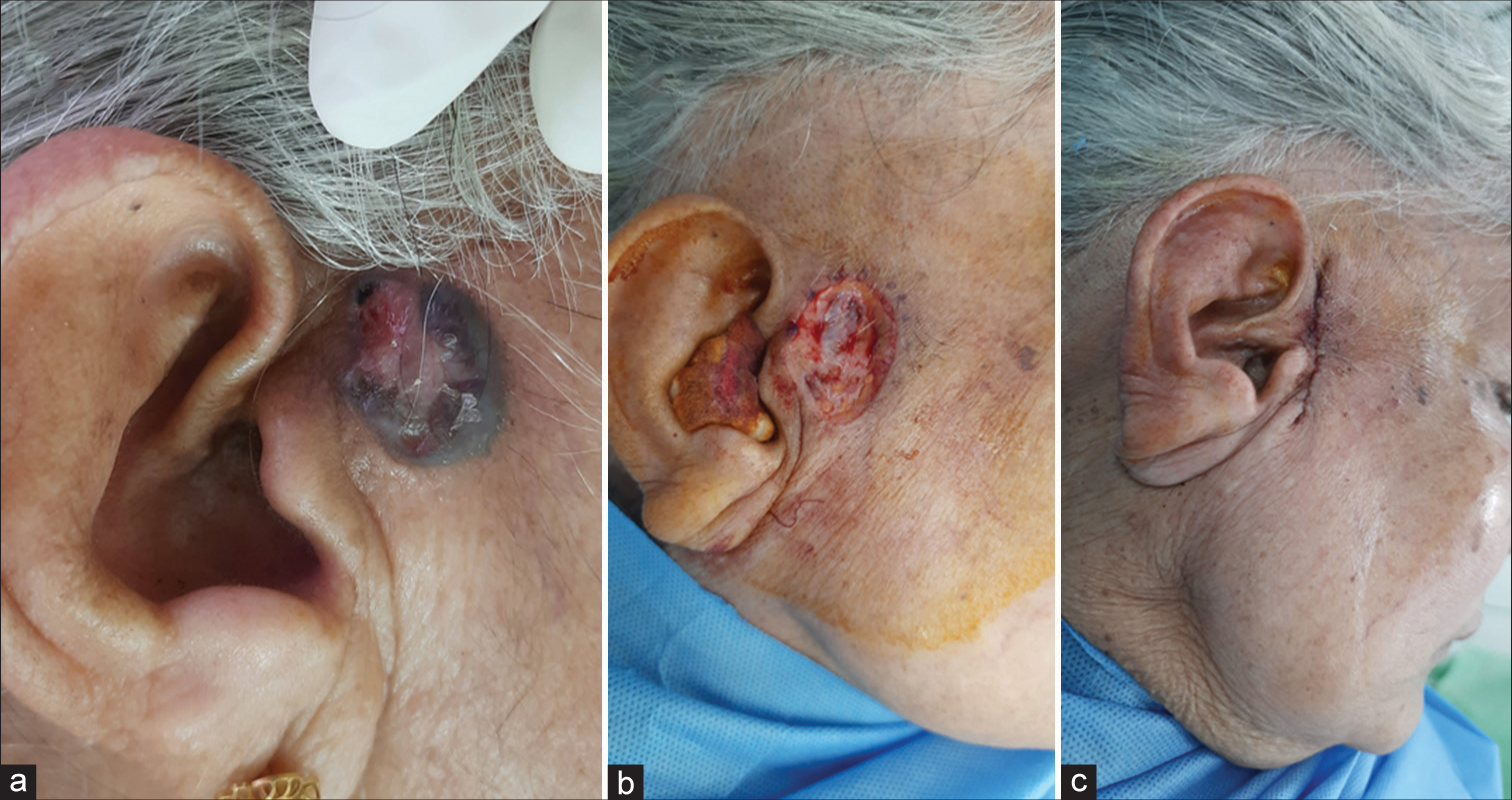 Success of Mohs surgery in the treatment of basal cell carcinoma in a tier two city in India