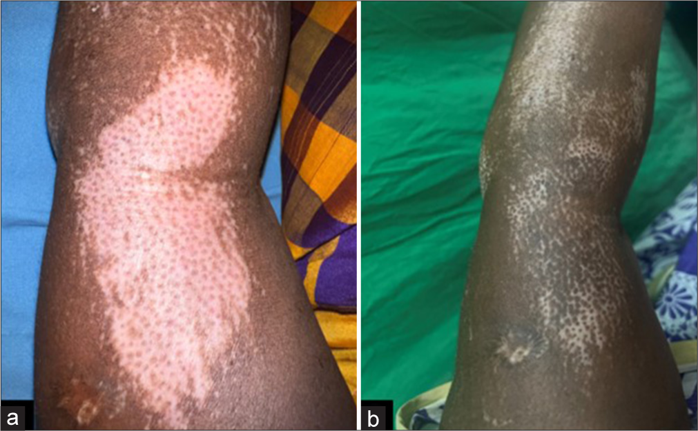 Efficacy of non-cultured non-trypsinized dermabraded epidermal cell graft followed by narrowband ultraviolet B phototherapy in stable vitiligo