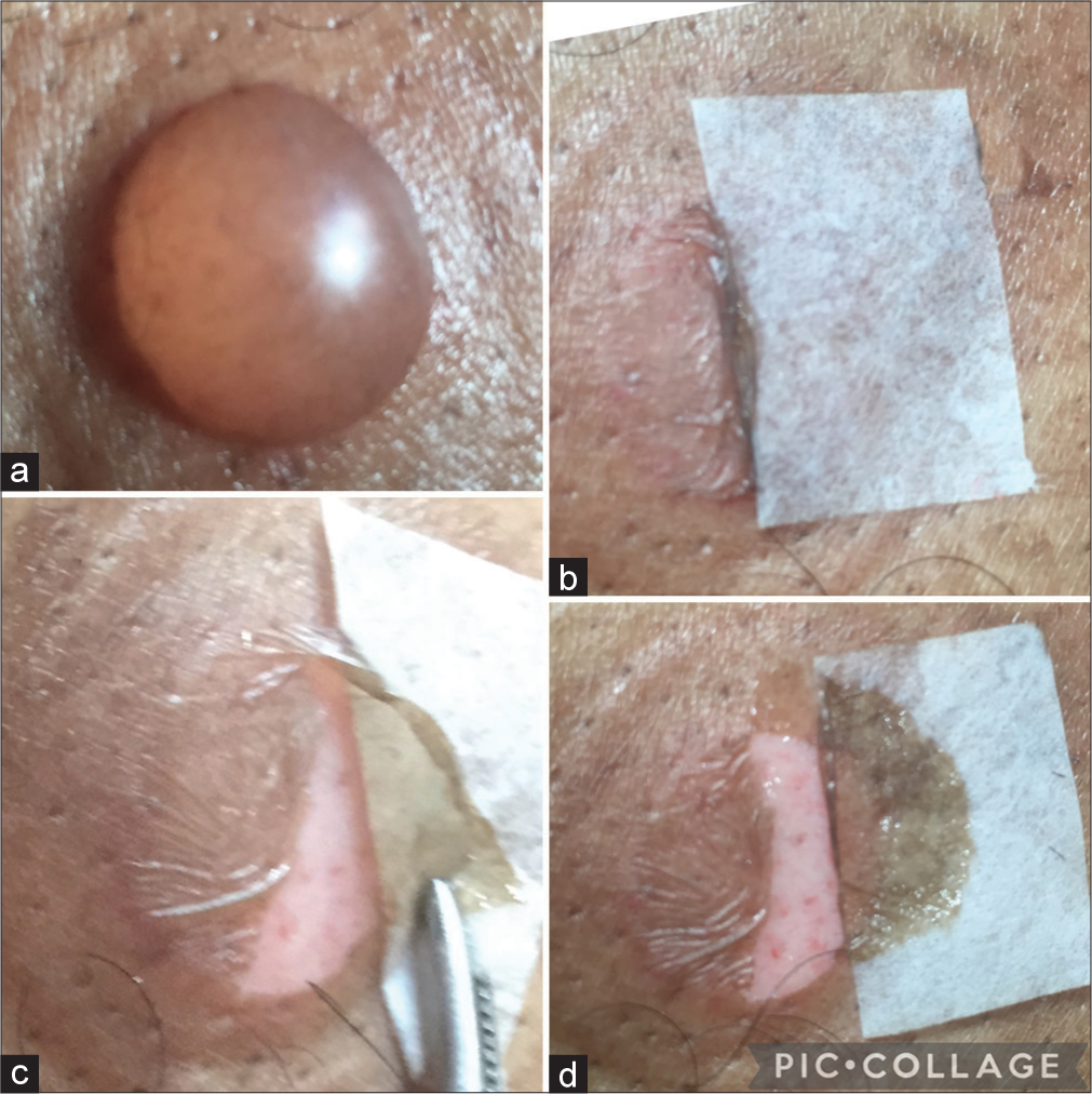 Surgical pearl: Use of micropore tape for easy harvestation and transfer of suction blister epidermal graft