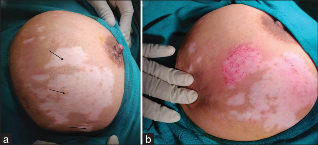 Purpura during dermabrasion: A false endpoint in vitiligo surgery over atrophic lesions