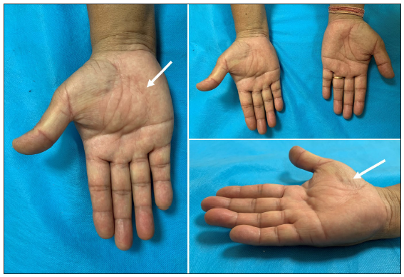 Giant palmar lipoma with median nerve neuropathy: A case report and review of literature