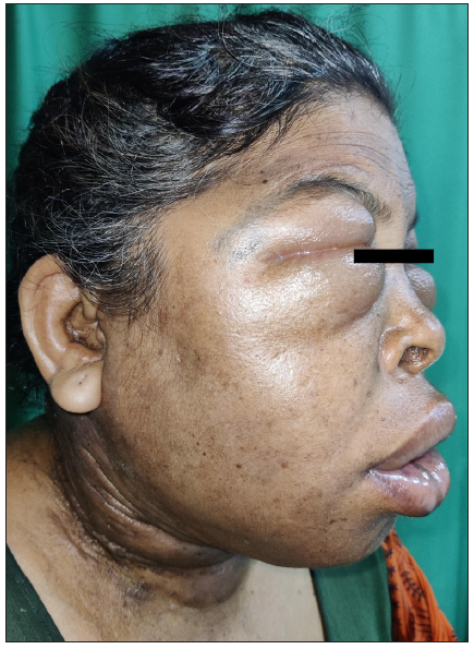 Oral cavity squamous cell carcinoma complicated by internal jugular vein thrombosis