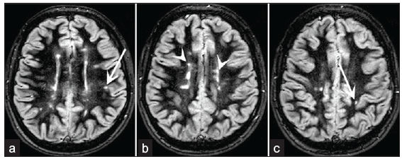 Comparative analysis of double inversion recovery (DIR) and diffusion tensor imaging (DTI) sequences for the detection of brain white matter diseases