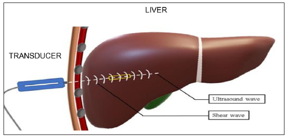 Transient elastography for non-invasive assessment of liver fibrosis