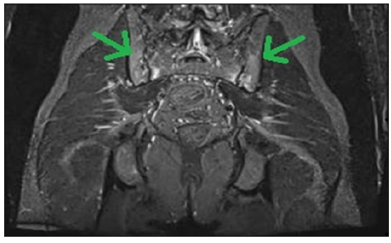 Asymptomatic pulseless disease in upper limbs: An unusual presentation of ankylosing spondylitis