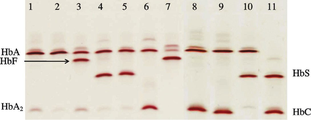 Abnormal haemoglobins: detection & characterization