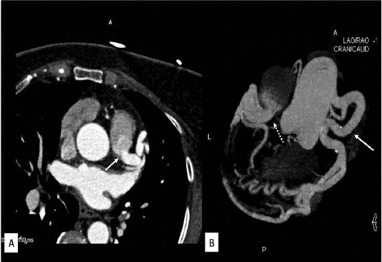 Anomalous origin of left coronary artery in an adult